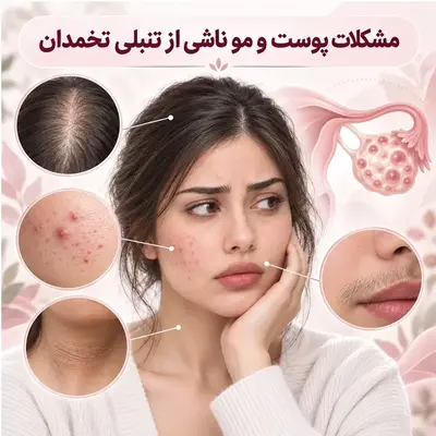 مشکلات پوست و مو ناشی از تنبلی تخمدان